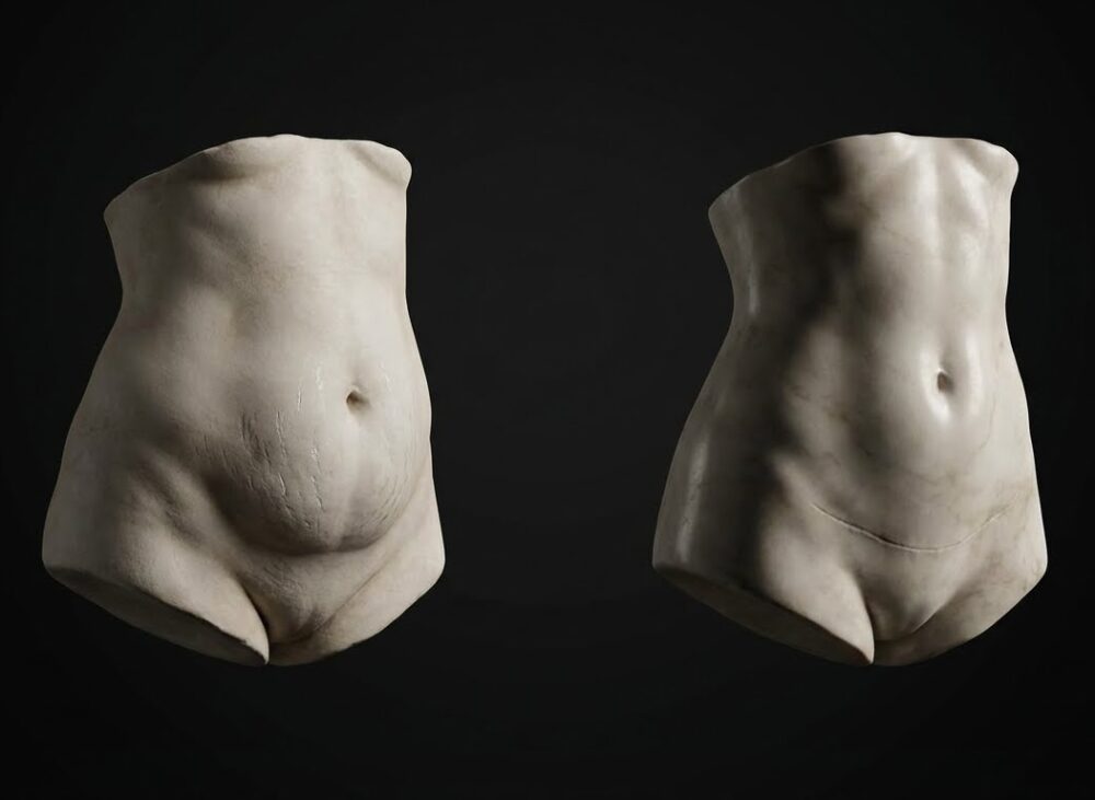 Abdominoplastia
