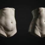 Abdominoplastia