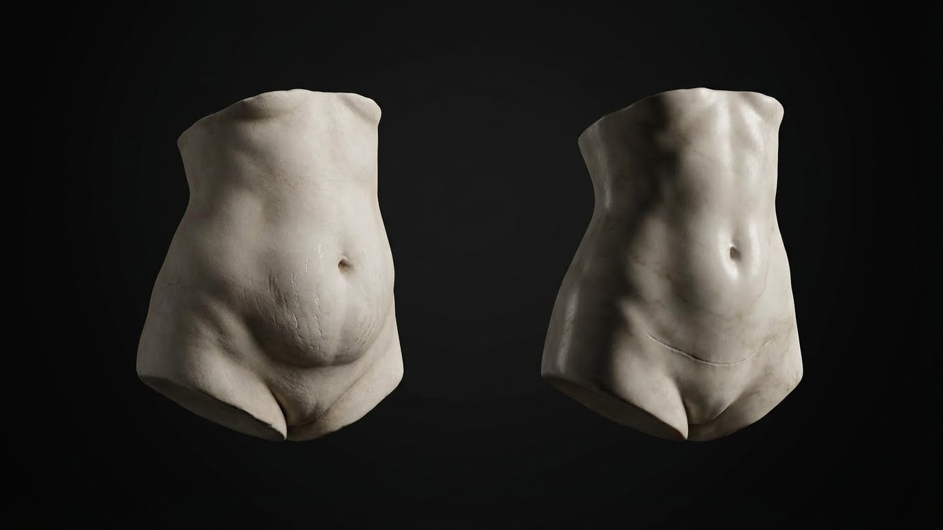 Abdominoplastia